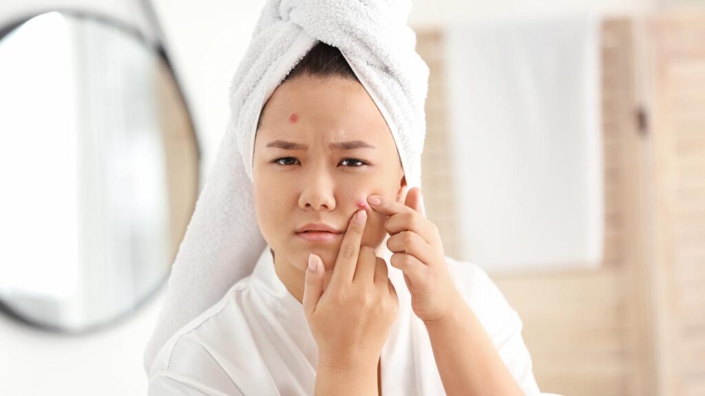 A woman experiencing hormonal acne
