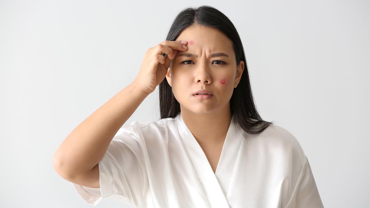 A woman having an acne breakouts and acne blemishes