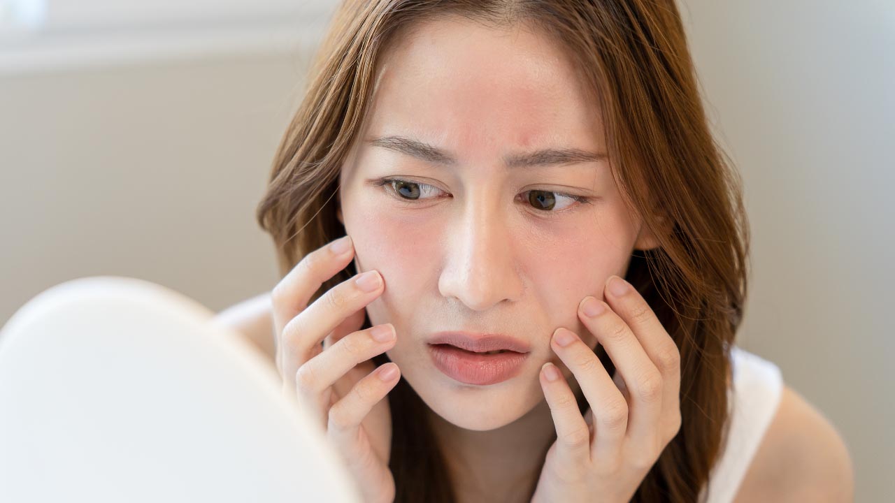 A woman with a dry thin skin barrier due to over exfoliation