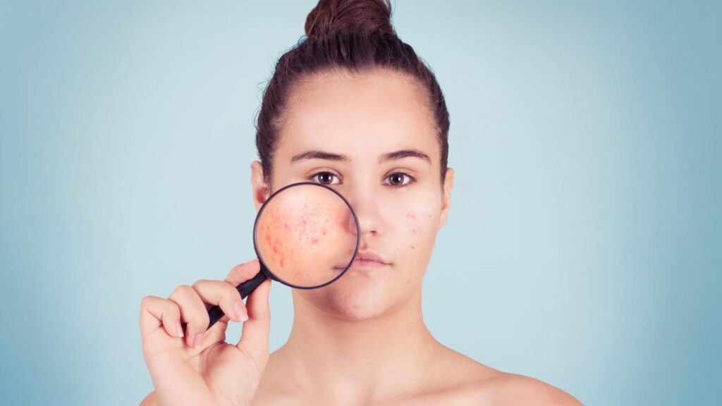 A woman with inflammatory acne and acne scarring