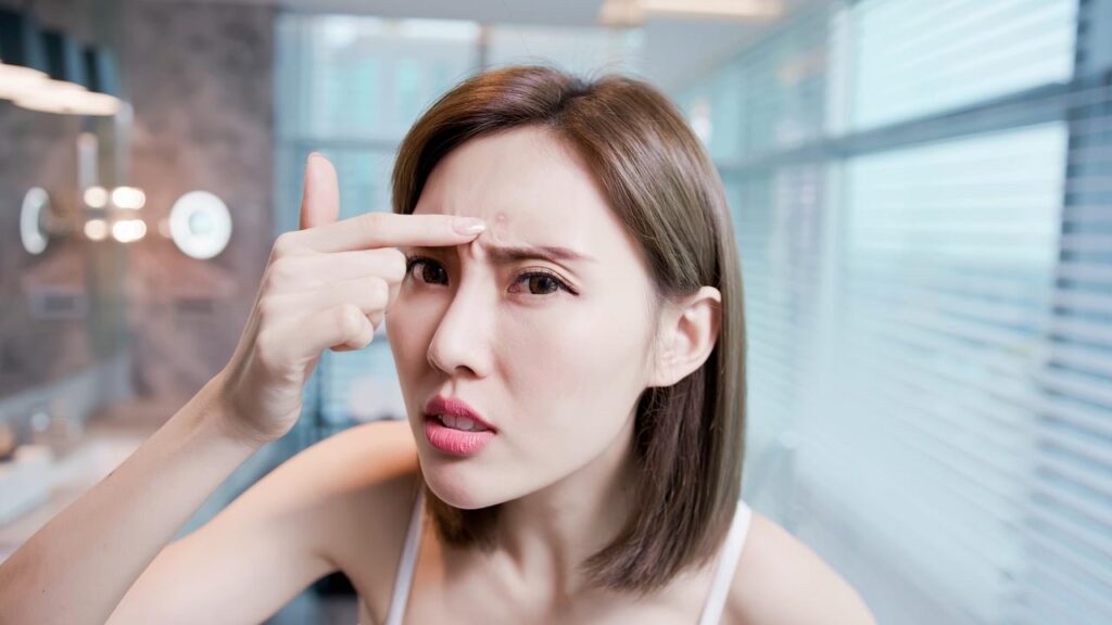 Skincare Routine for Acne-Prone Skin