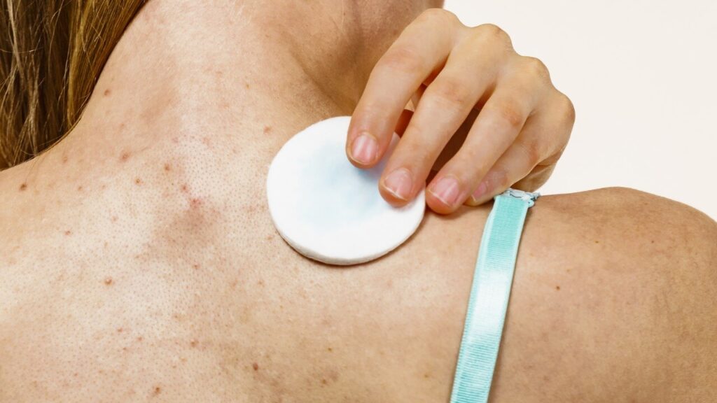backacne-treatment