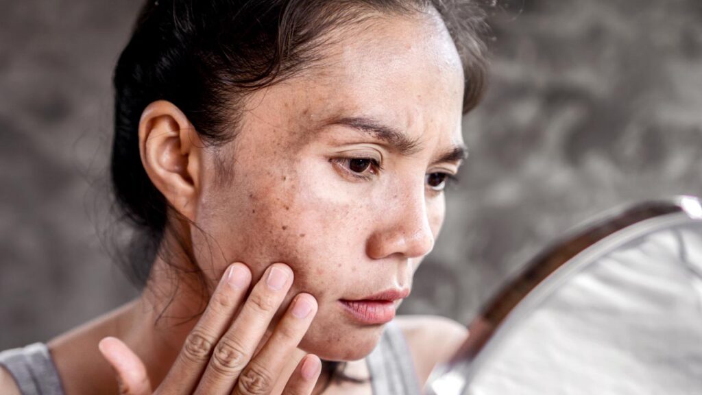 post inflammatory hyperpigmentation treatments