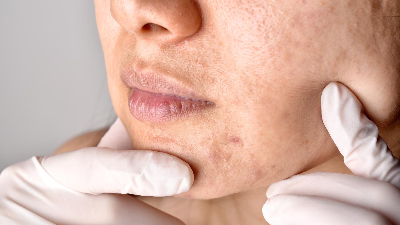 postinflammatory hyperpigmentation